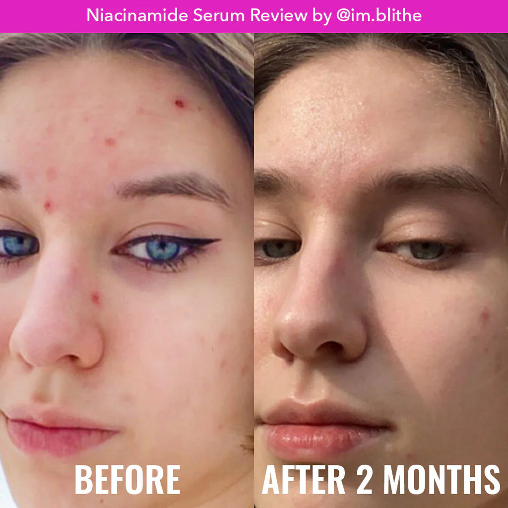 Niacinamide Serum Good Molecules Suero De Niacinamida